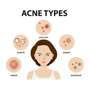 Acne-UV Gel SPF-50 (50 gm)